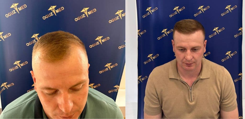 До · После