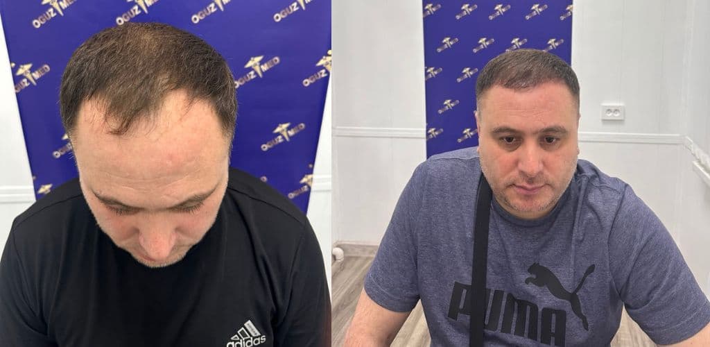 До · После