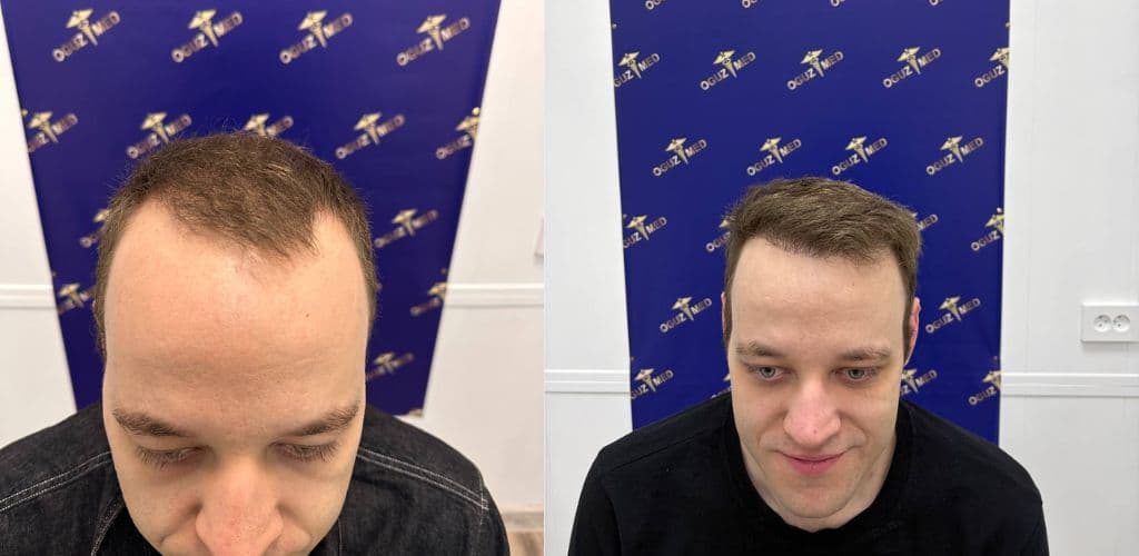 До · После